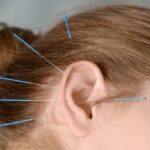 Agopuntura auricolare: come funziona e quali benefici offre