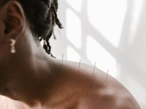 Agopuntura per la cervicale: quando considerarla come trattamento